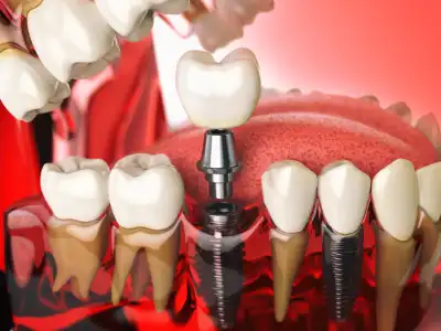 How dental implant be done