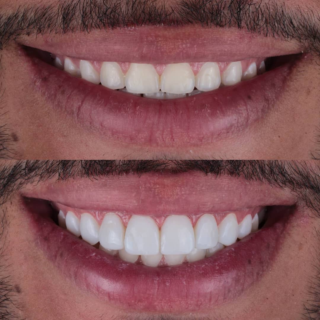 Smile Design in Istanbul