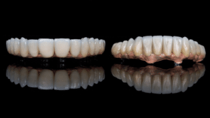 emax-crowns, dental veneers